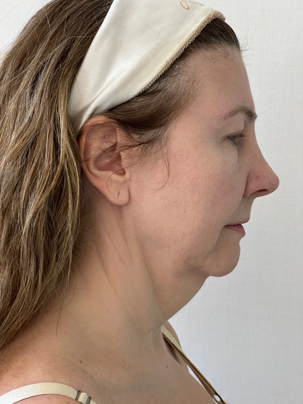 Antes — Rejuvenescimento facial
