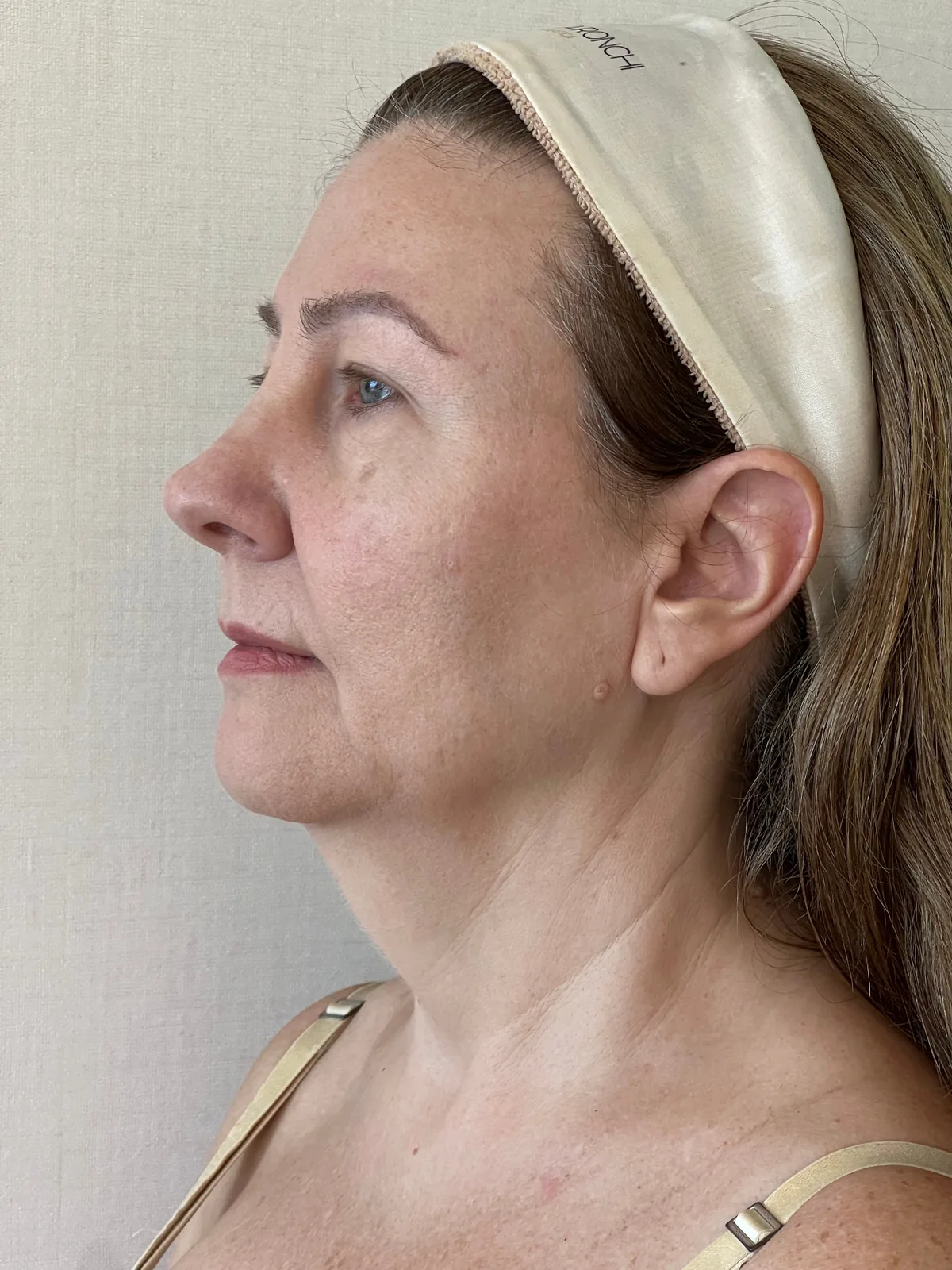 Antes — Lifting facial