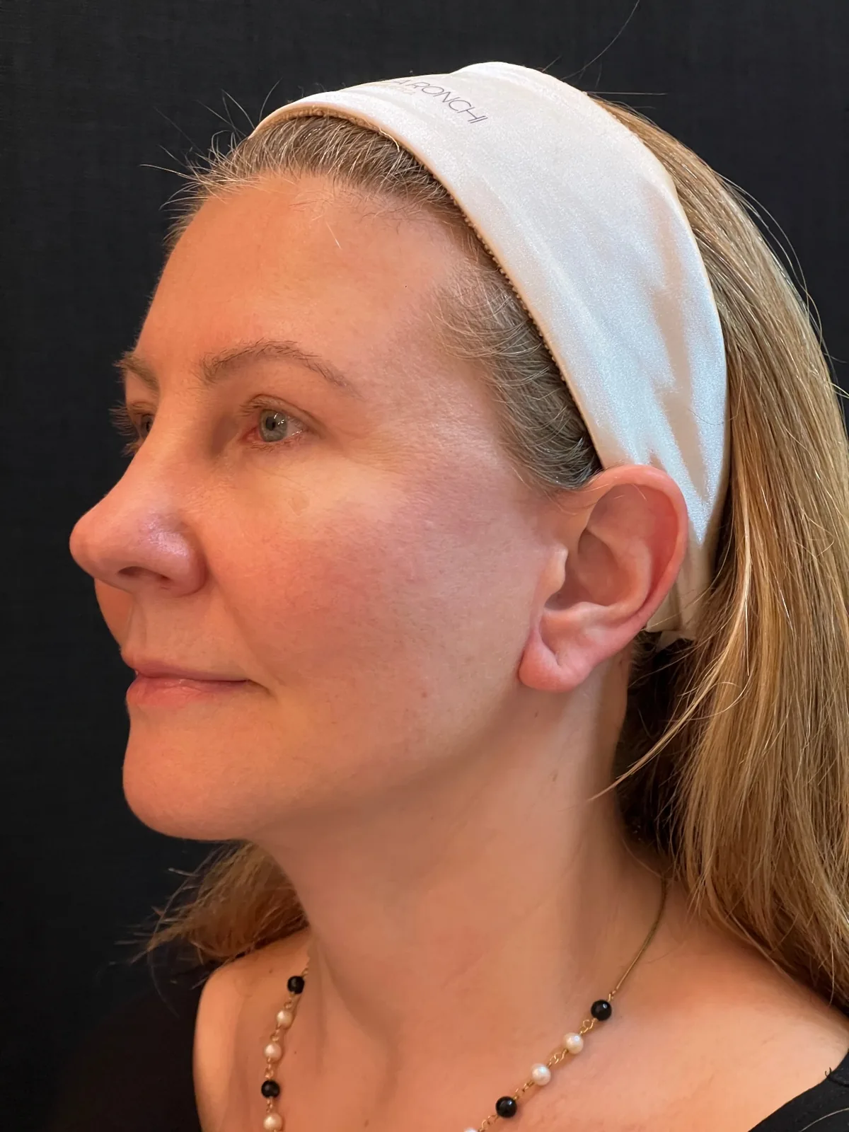 Depois — Rejuvenescimento facial