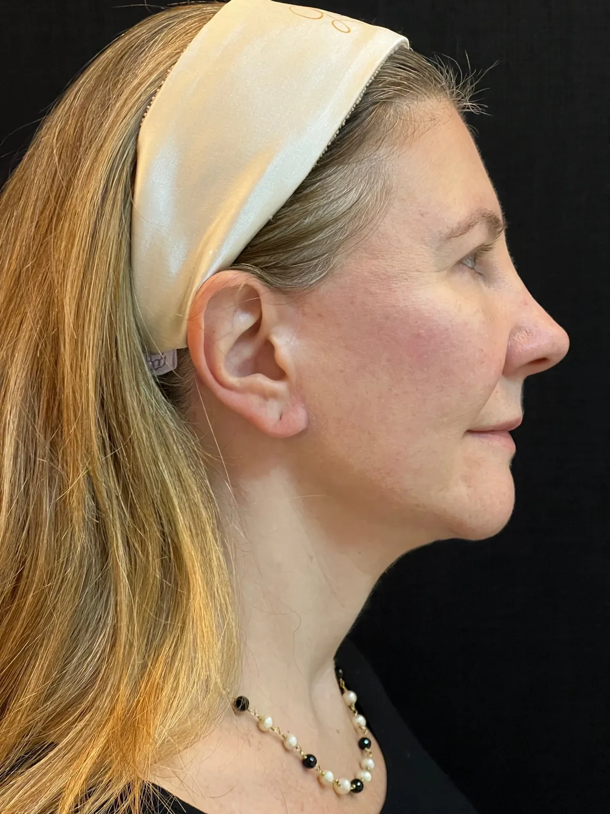 Depois — Lifting facial